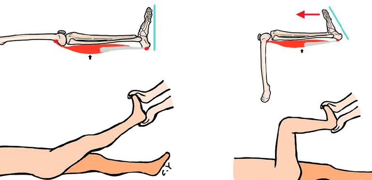 Silfverskiöld Test – Assessing Ankle Dorsiflexion & Gastrocnemius Tightness